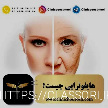 تخفیفان هایفو